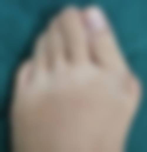 外切祛眼袋适合哪些人？