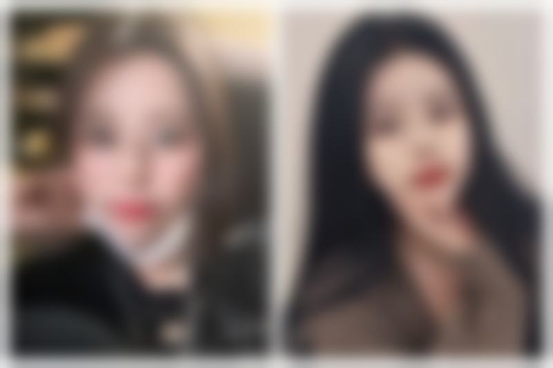 双眼皮术后不同阶段该怎么护理?