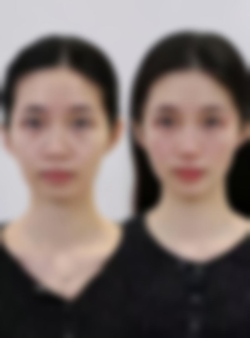 半年后仍存在问题需要手术调整吗？