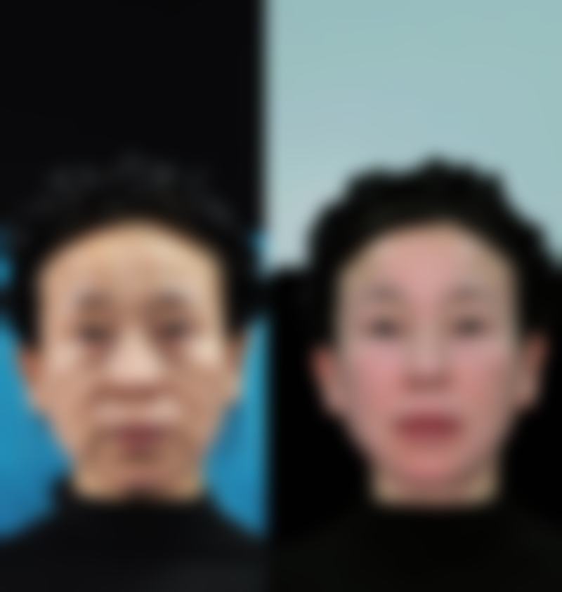 泪沟明显但没有重度眼袋,有什么改善方案?