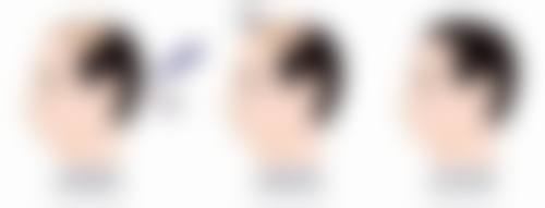 有哪些有效治疗方案？