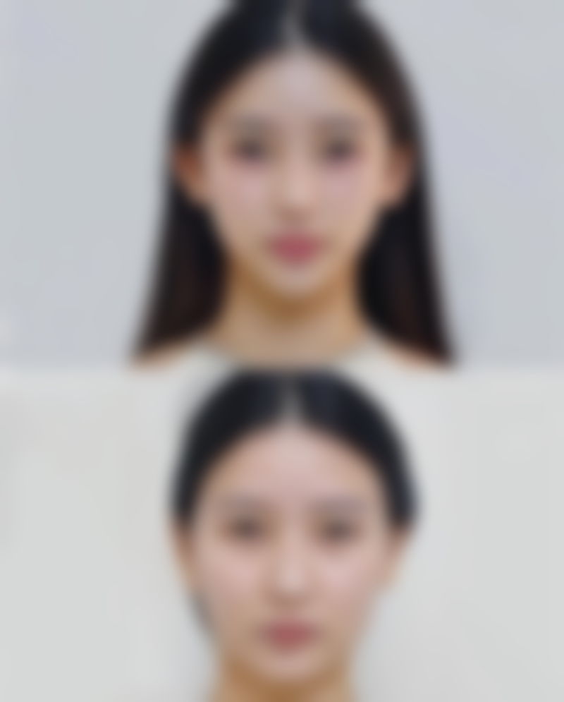 面部抽脂手术多久可以完全恢复？揭秘恢复过程中的关键因素与注意事项！恢复快慢受哪些因素影响？ 