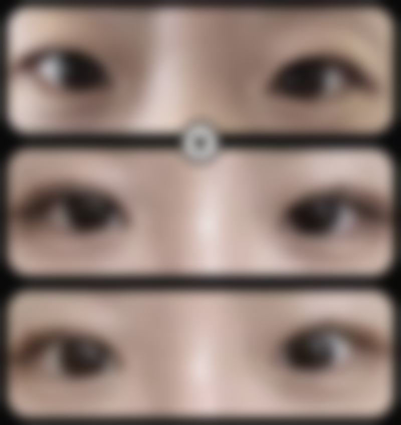 脂肪细胞特性对抽脂后反弹有什么影响?