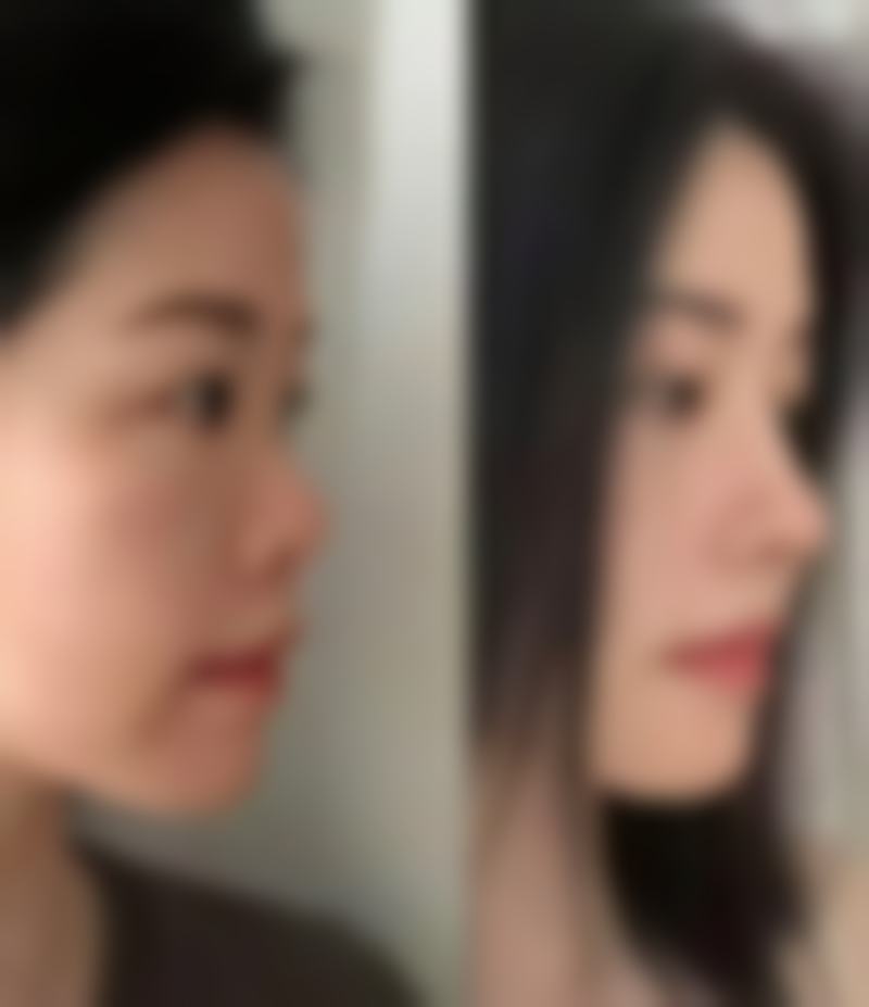 三点定位法(微创三点法)适合什么样的人?