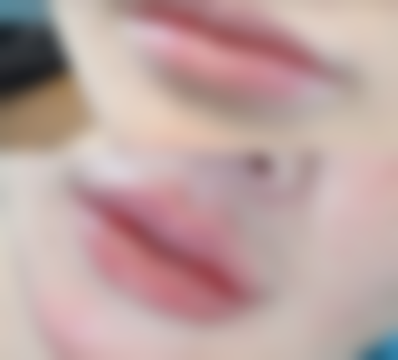 全切双眼皮第二天右眼眼皮外翻重度怎么办？