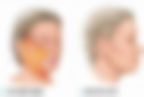 手术可以祛眼袋吗？揭秘眼袋手术的真实效果与风险！哪种手术方式更适合你？