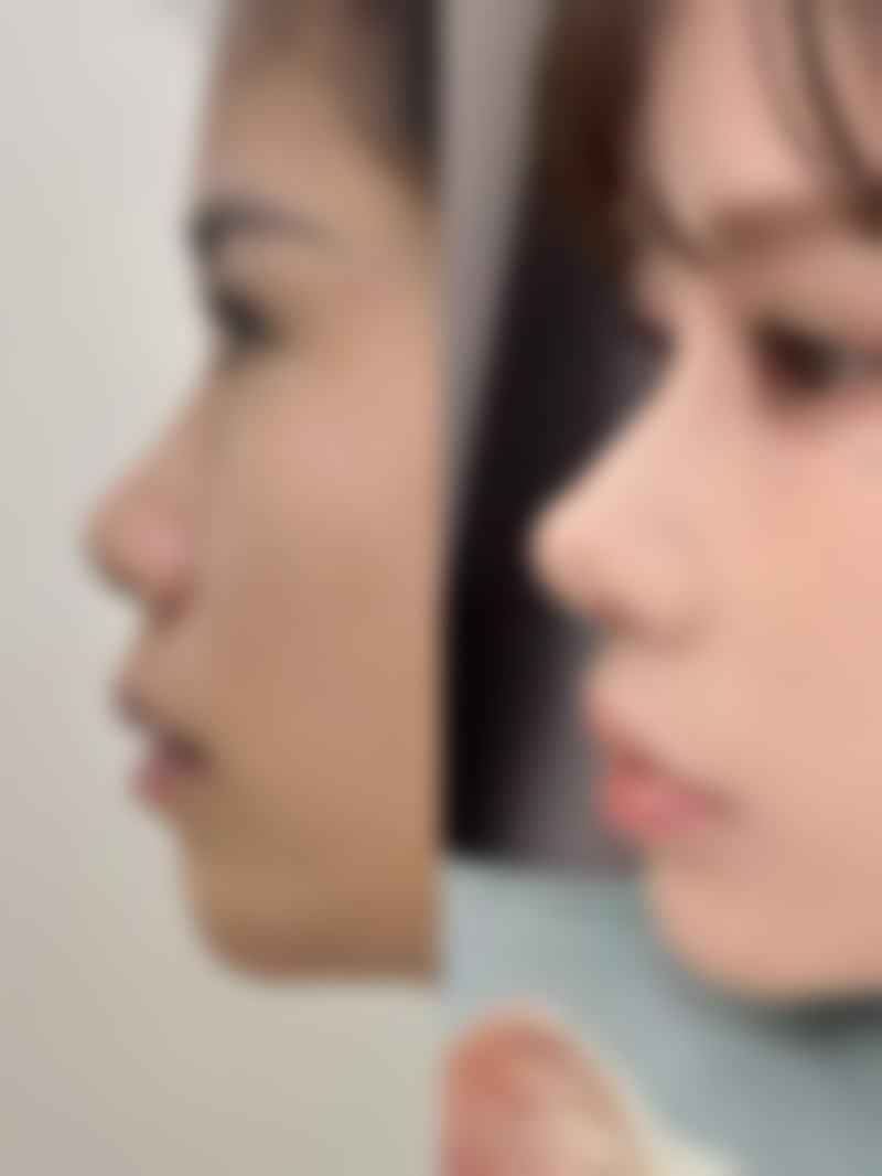 手术祛眼袋的真实成效如何？