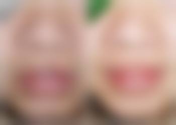 怎样选择合适的医生进行双眼皮手术？