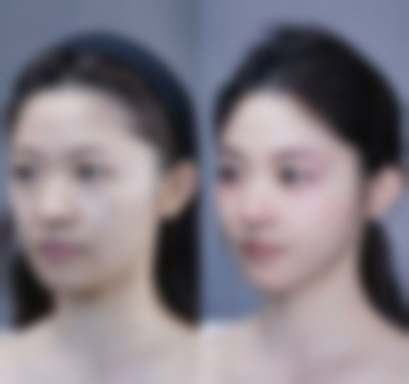 自体脂肪填充丰太阳穴适合哪些人？