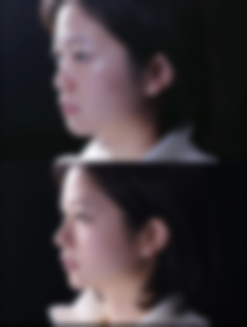 什么丰太阳穴有效果？揭秘医美行业的真实效果与选择指南！玻尿酸和自体脂肪填充是优选吗？ 