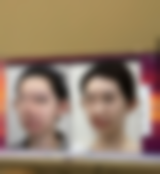 线提升提升和注射胶原蛋白丰太阳穴有什么特点？