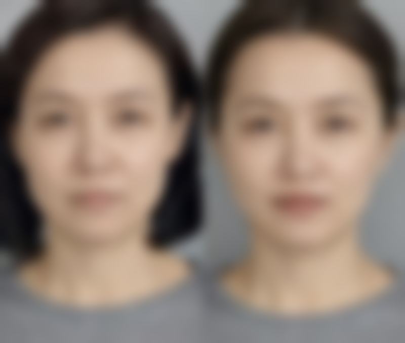 外切法去眼袋：全方面解决，长久维持