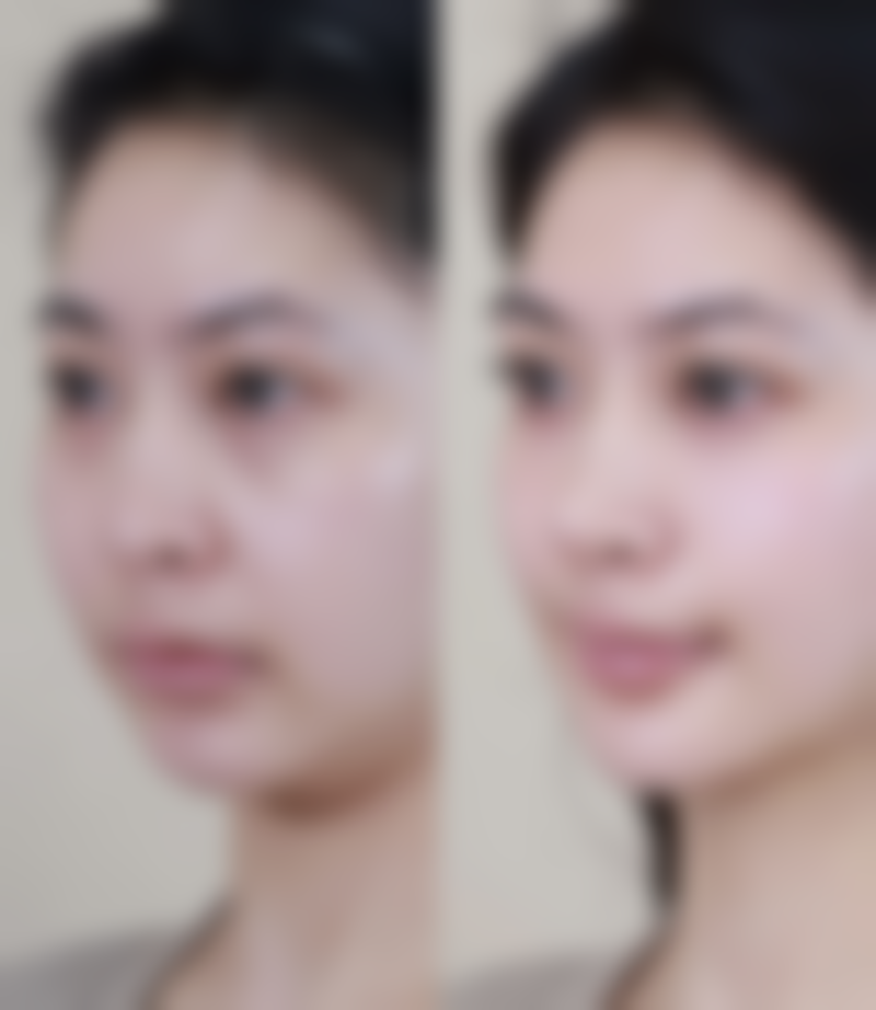 为什么建议到正规医疗机构取出隆胸假体？