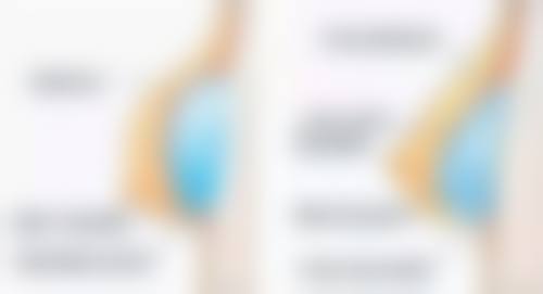 激光去眼袋的操作流程是怎样的?