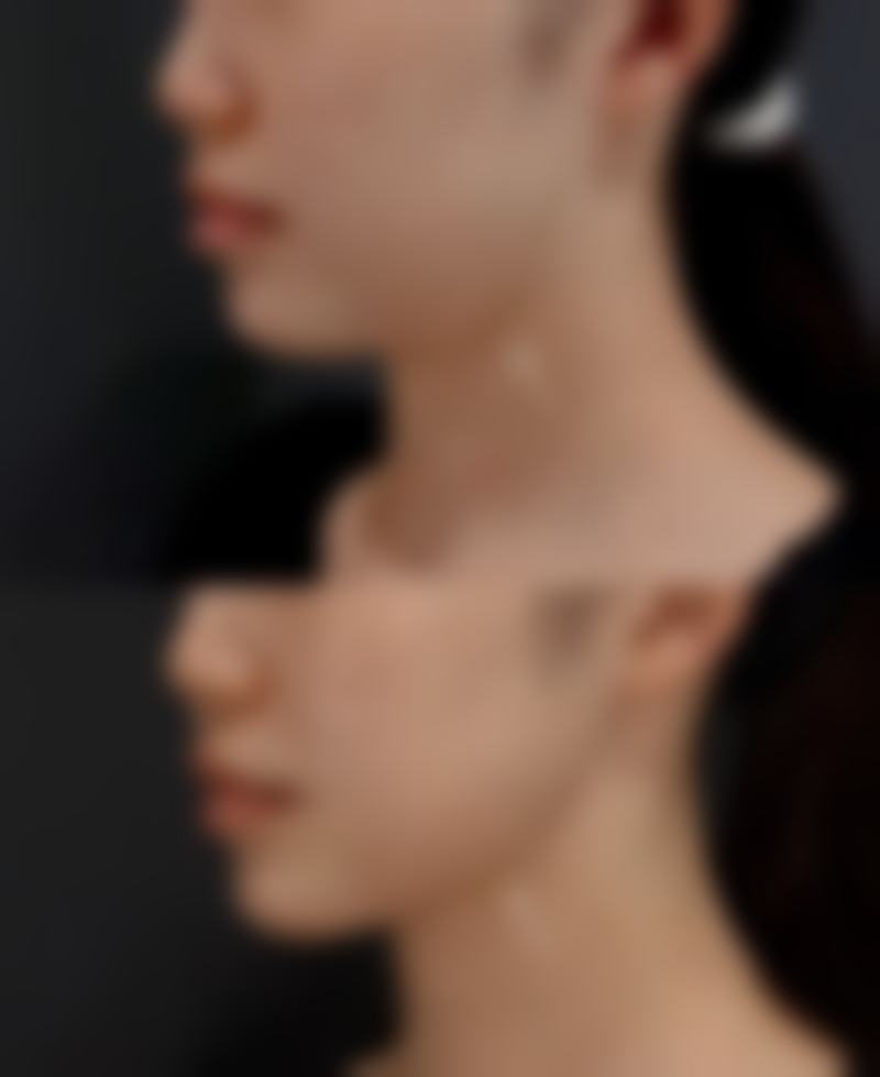 判定疤痕体质有哪些注意事项和误区?