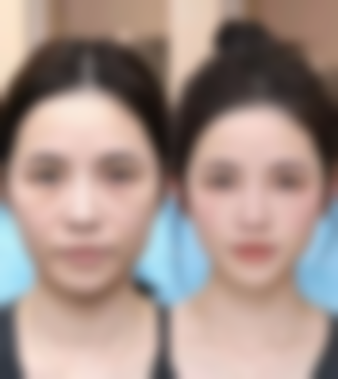 埋线法的优势又是什么呢？