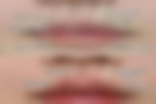 内切法去眼袋手术是怎样操作的，有什么优势和注意事项？