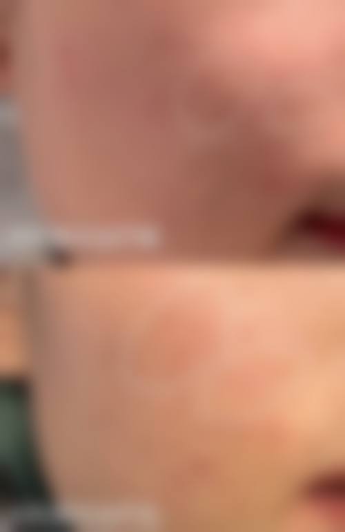 伤口破了怎么不留疤痕？有效护理技巧之愈合期护理要点