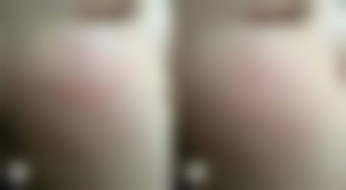 眶隔脂肪释放术有什么特点，适合哪些人群，术后要注意什么？