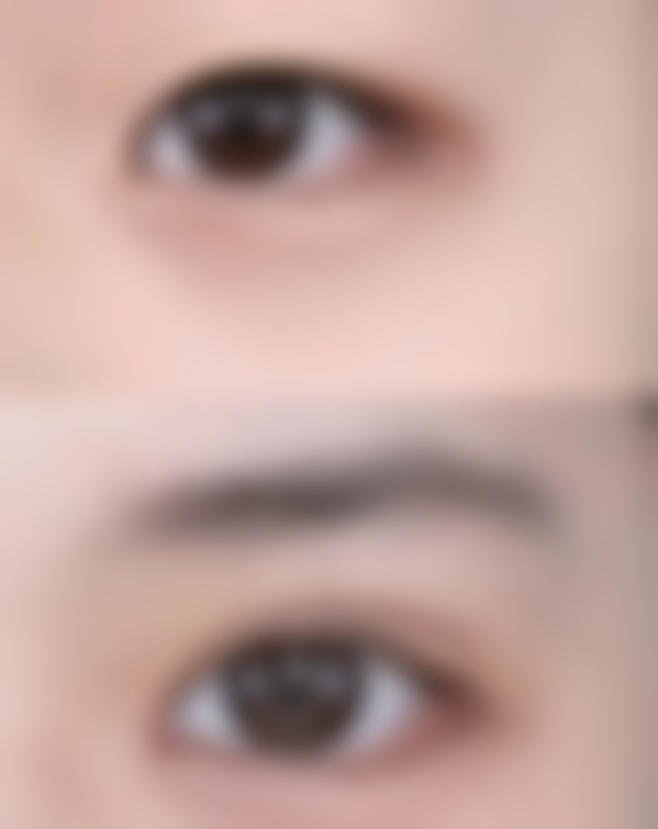 去眼袋手术后伤口该如何护理？