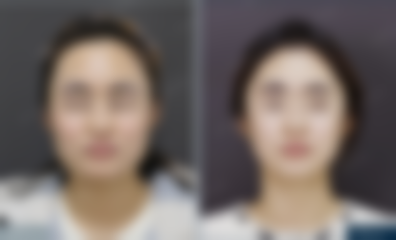 北京圣嘉新医疗美容医院助25岁姑娘改善下颌角方盒感，成角截骨+颧骨内推效果超棒！ 