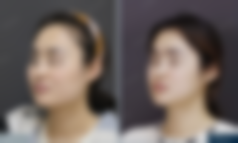 北京圣嘉新医疗美容医院助25岁姑娘改善下颌角方盒感，成角截骨+颧骨内推，术前准备都有啥呢？