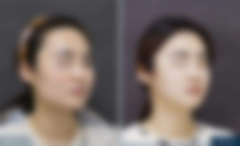 北京圣嘉新医疗美容医院助25岁姑娘改善下颌角方盒感，成角截骨+颧骨内推，手术过程咋样呢？