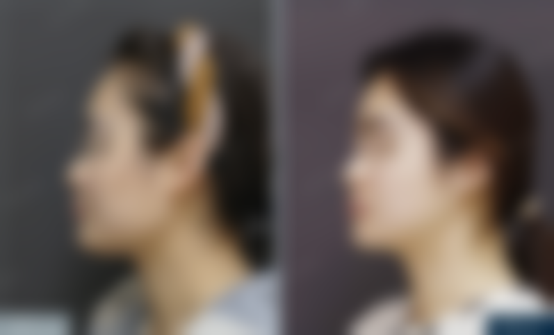 北京圣嘉新医疗美容医院助25岁姑娘改善下颌角方盒感，成角截骨+颧骨内推，术后修复成效如何呢？