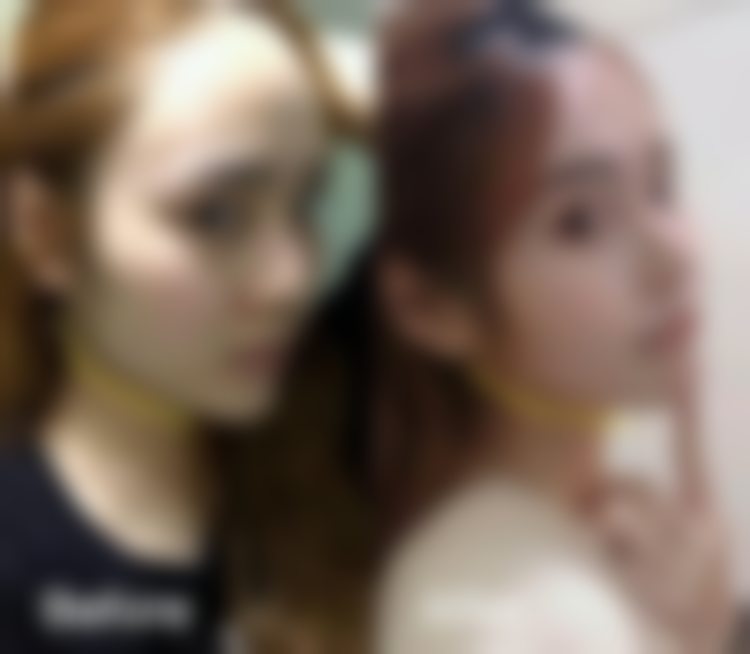 杭州连天美医疗美容医院玻尿酸除皱项目用的是什么产品？