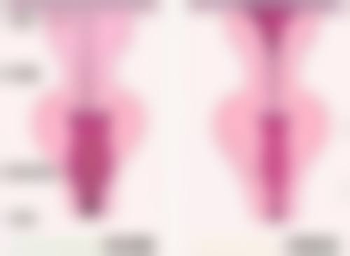 玻尿酸丰太阳穴注射后有哪些注意事项呢?