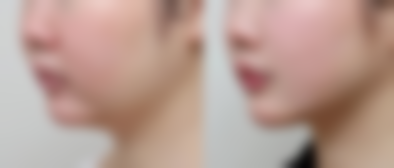 眼袋手术有哪些通用的术后护理要点呢？