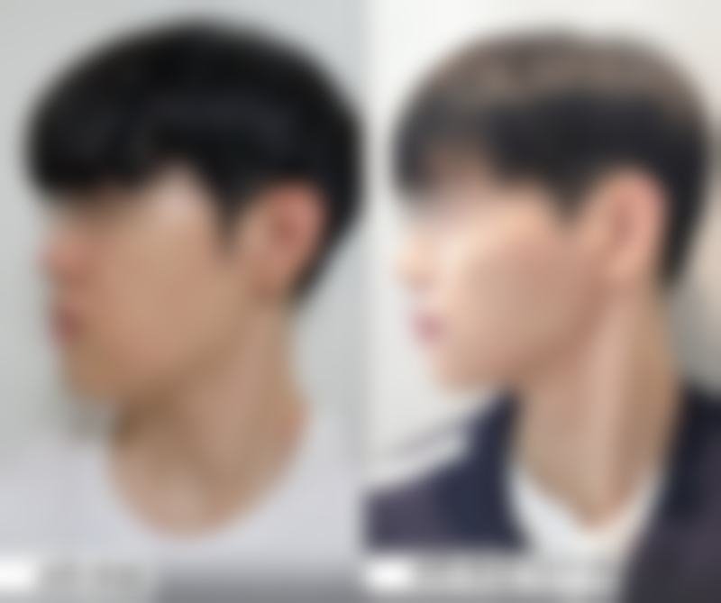 疤痕增生可以用激光打掉吗？专家解析激光治疗的真实效果与风险！效果显著但有啥风险？ 