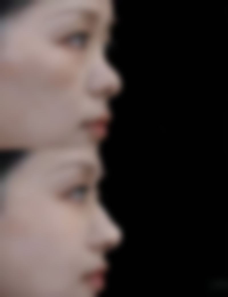 济南市艺星整形美容医院有限公司杨季涛医生膨体隆鼻技术怎么样？