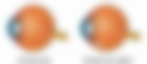 抽脂后会出现慢性疼痛吗？