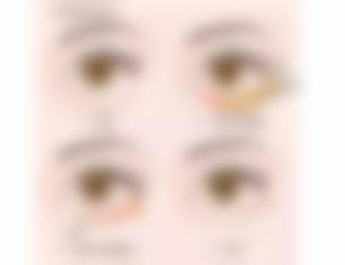 抽脂手术的麻醉有哪些风险？