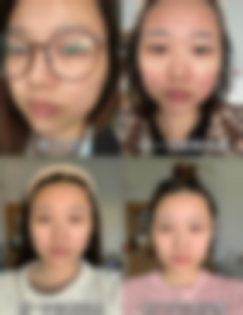 合肥第一人民医院整形美容分院青纪鸿医生隆鼻技术怎么样？