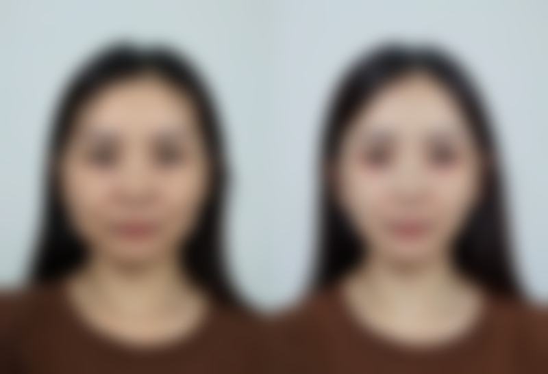 药物治疗能消除眼袋吗？