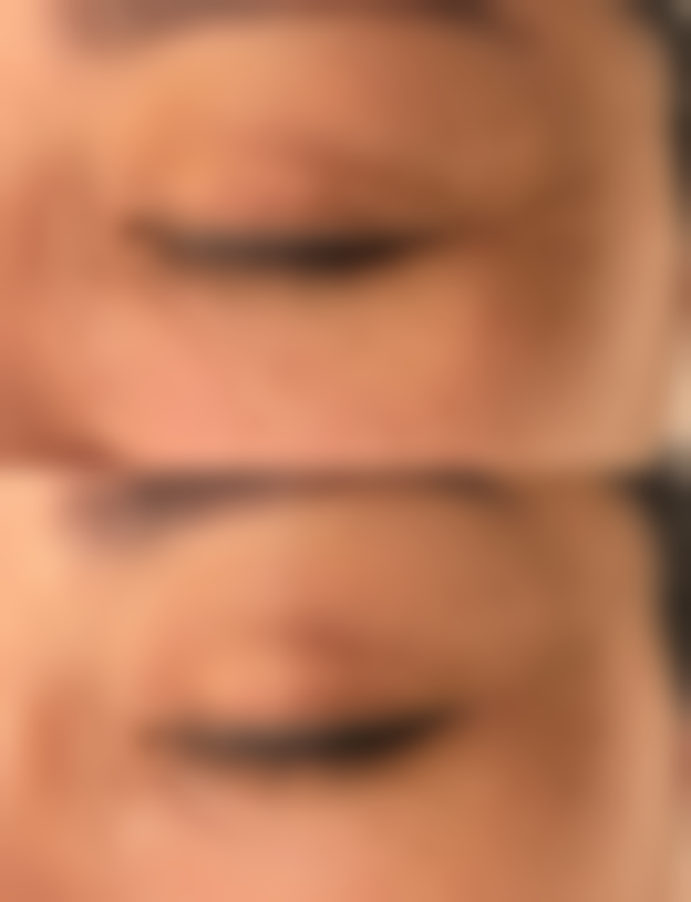 抽脂后皮肤松弛怎么办？