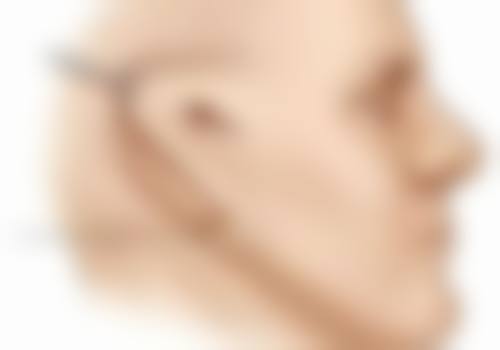 疤痕子宫是怎么形成的呢？