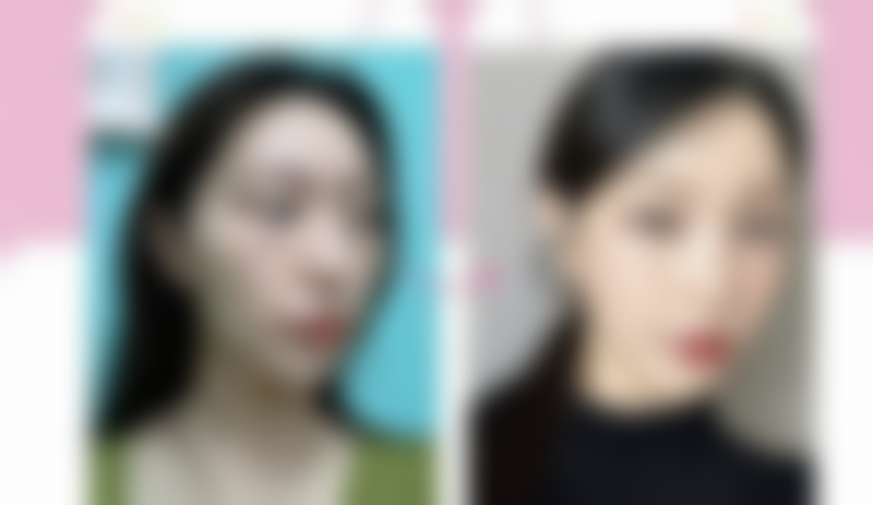 去除眼袋手术有哪些注意事项?