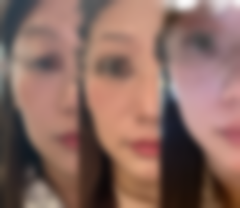 去除眼袋手术后的护理要点有哪些?