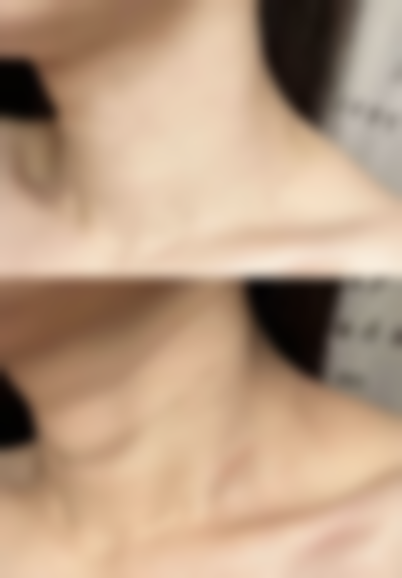 济南市艺星整形美容医院有限公司杨季涛医生注射缩鼻头技术怎么样？