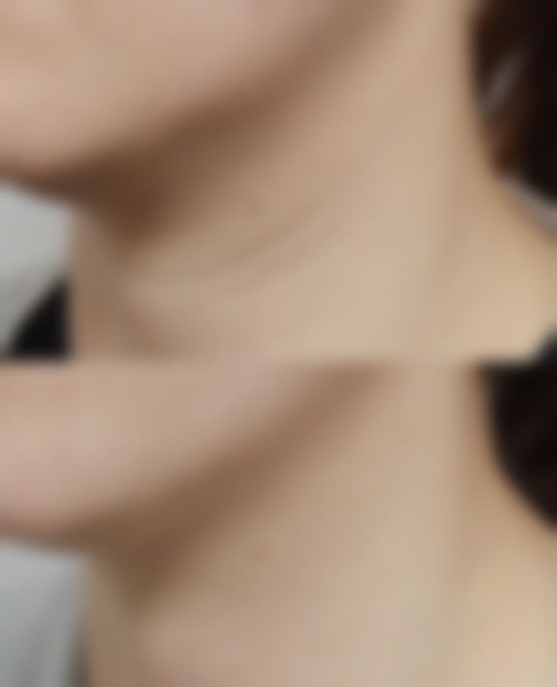 常见的去除眼袋手术术式有哪些,分别适合什么人群?