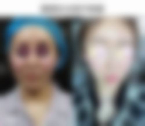 选择什么样的机构进行去眼袋手术更安心?