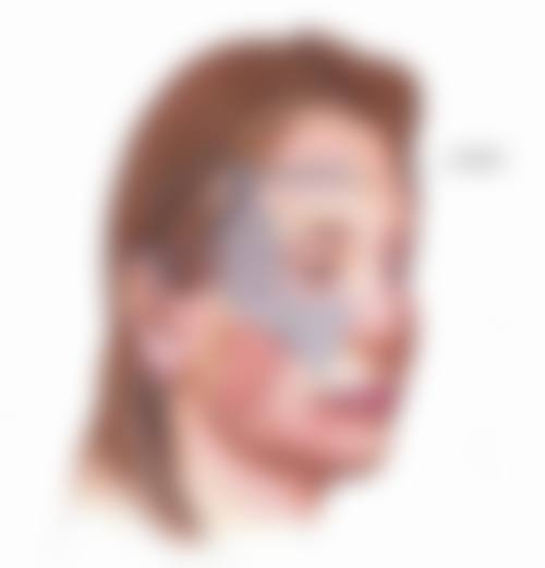 如何规避去眼袋手术的风险?