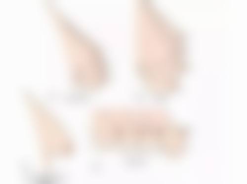 广州更自信医学美容专科门诊部曾梁宏医生玻尿酸隆鼻技术怎么样？