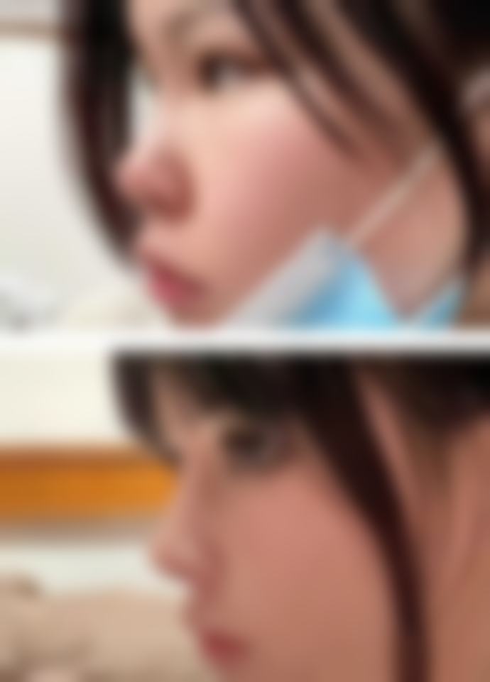 积雪苷祛疤成效究竟如何？真实实例分享