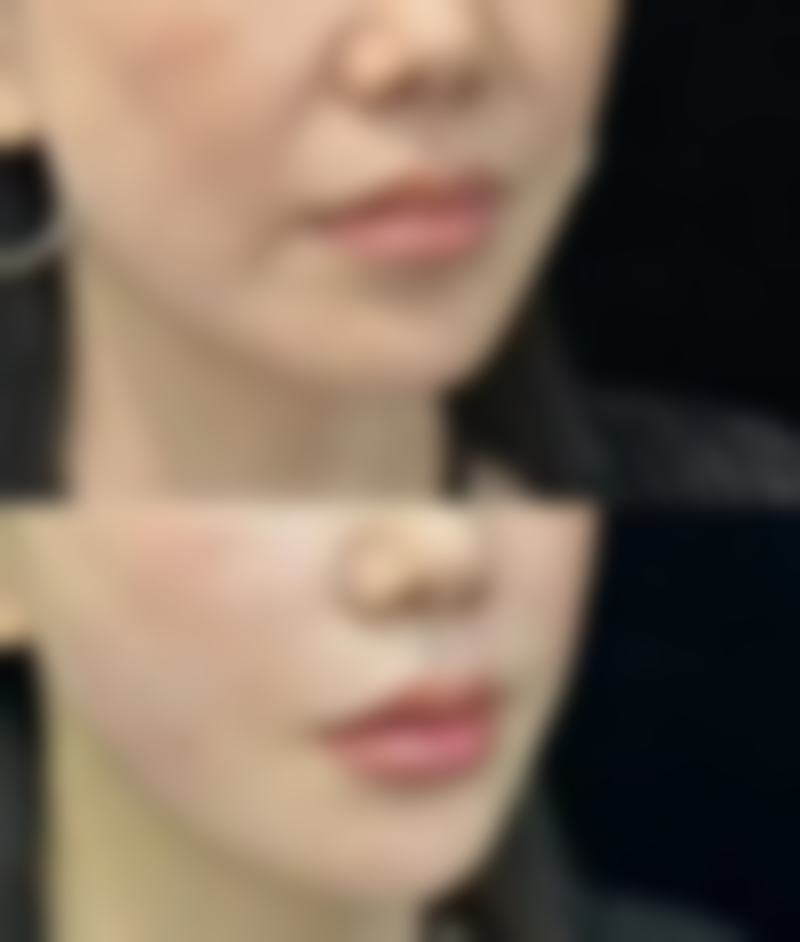 双眼皮修复术后怎么护理？