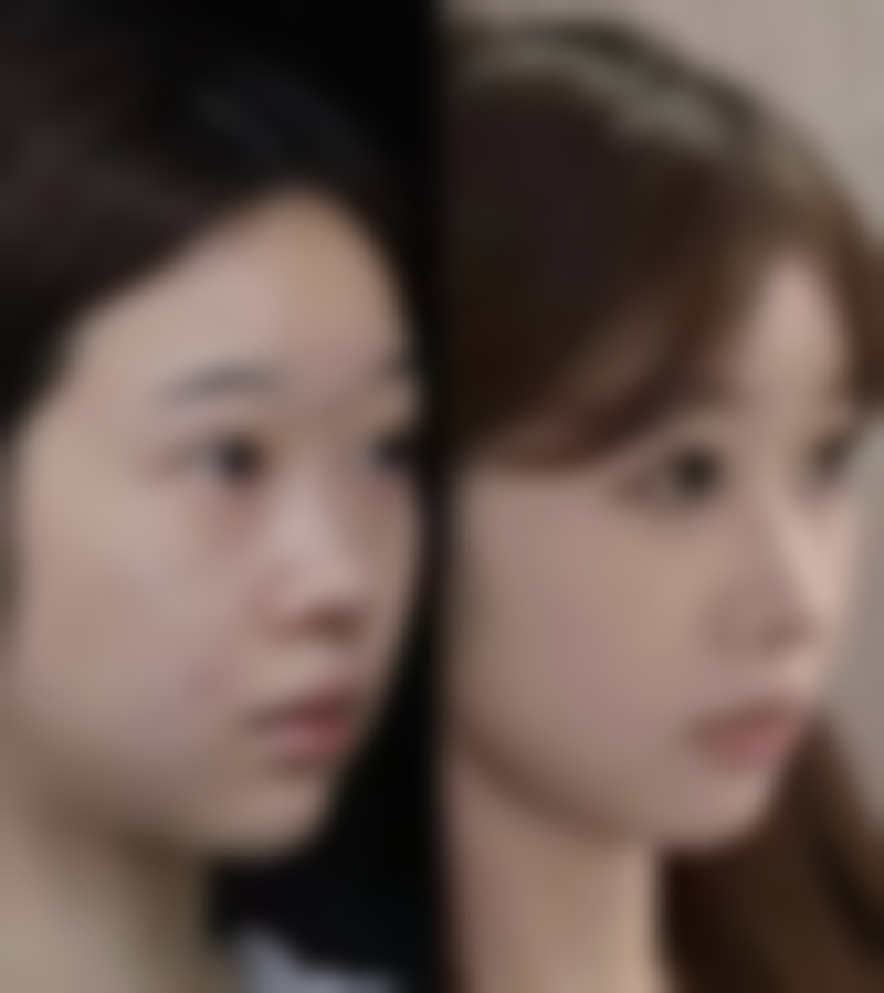 切开双眼皮过宽在不同场景下怎么修复？