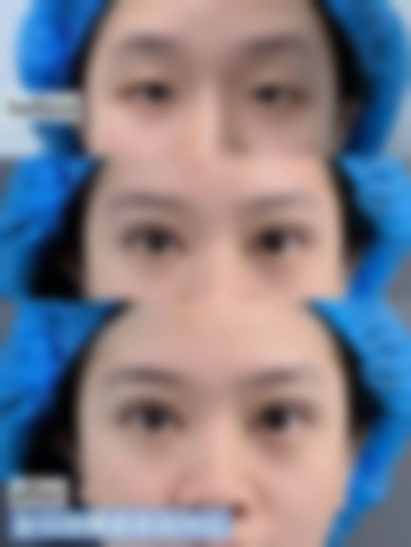 射频治疗是如何改善眼袋外观的？